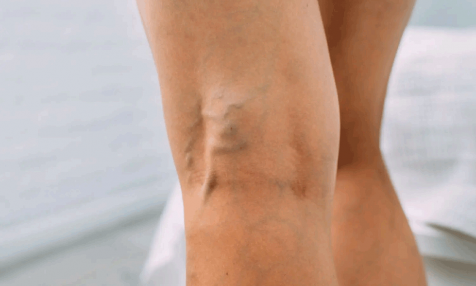 Global Health Focus International Program Trains Medical Professionals in Phlebology and Venous Pathologies