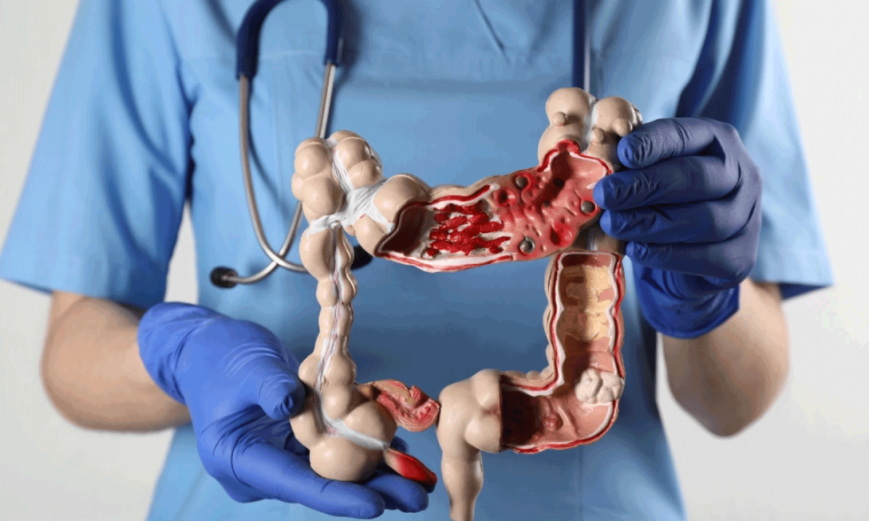 Alarming Rise in Early Stage Colon Cancer in Younger Adults Sparks Global Health Concern
