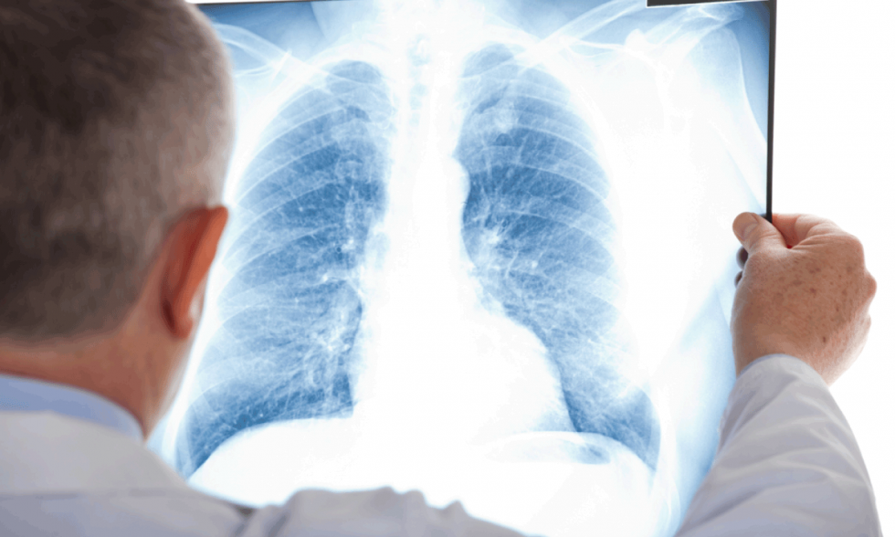 Low Dose CT Screening Could Prevent Three Times More Lung Cancer Deaths, New Study Finds
